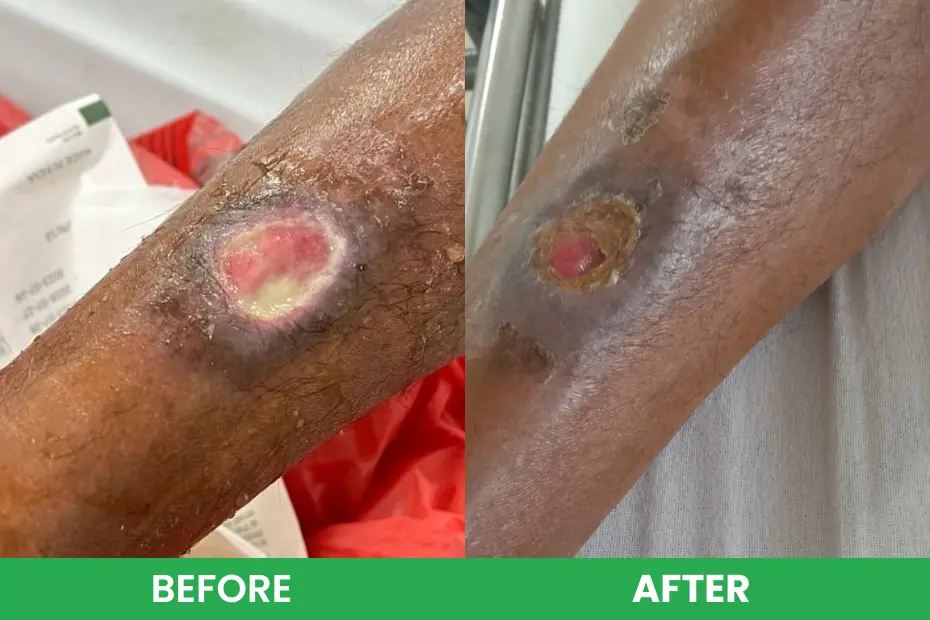 Advance wound care dressing in India