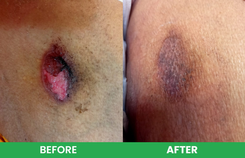 Before and after comparison showing an open pressure wound healing and forming healthy healed skin.