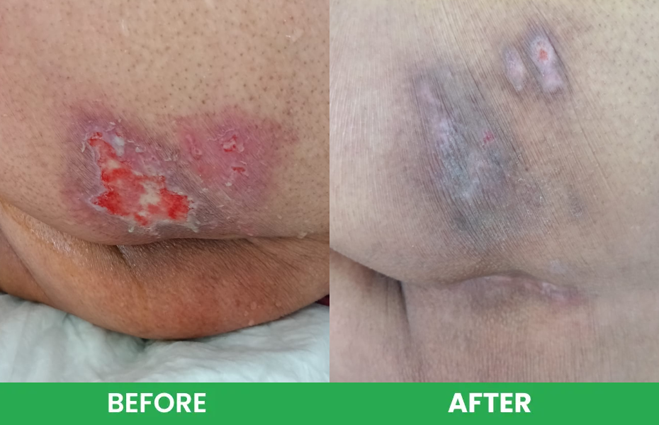 Before and after image showing a superficial bed sore wound improving with wound care and healing treatment