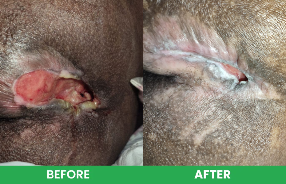 Before and after image showing healing progress of an open bed sore wound in a skin fold area